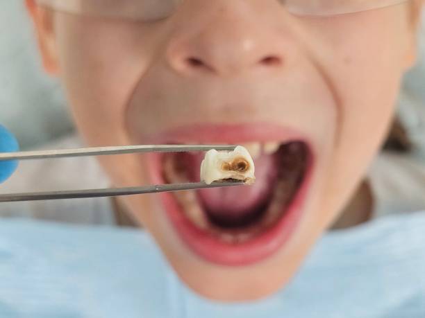 Best Emergency Tooth Extraction in Dyersville, IA